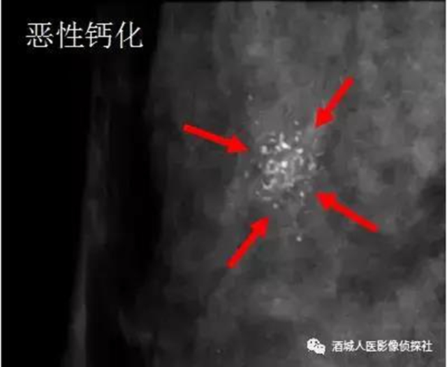 鉬靶、超聲、磁共振...篩查早期乳腺癌到底該選啥？(圖2)