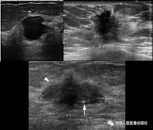 鉬靶、超聲、磁共振...篩查早期乳腺癌到底該選啥？(圖3)