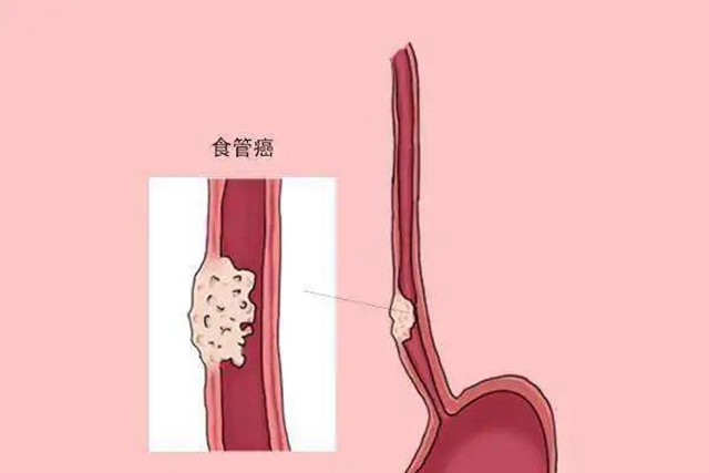 【警惕】大爺吃東西覺得哽，一查竟是癌！(圖7)