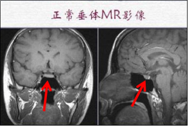 【擴(kuò)散】孩子長太高？警惕腦子出問題！(圖3)