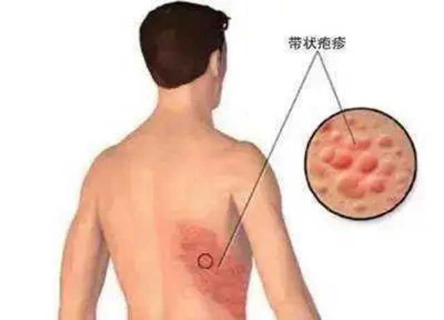 “蛇纏腰”可通過打疫苗預防，趕緊帶父母去打(圖4)