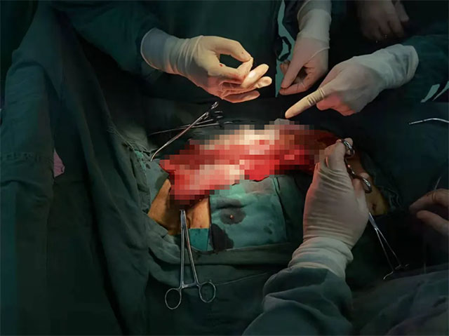 做了兩次結(jié)腸癌手術(shù)的大爺又中患食管癌，胸心外科助他重獲“新生”