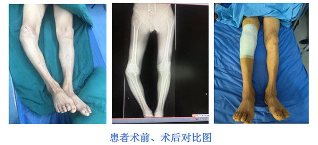 【?？萍夹g(shù)】全膝人工關(guān)節(jié)置換術(shù)，讓患者重燃行走“膝”望！