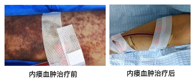 【病例分享】動(dòng)靜脈內(nèi)瘺出現(xiàn)皮下血腫怎么辦？