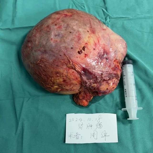 【技術(shù)】多科會(huì)戰(zhàn)，成功摘除右腎直徑20厘米巨大腫瘤！