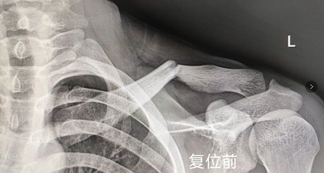 【圍觀】時隔一年，瀘州又一“爬樹哥”遭了