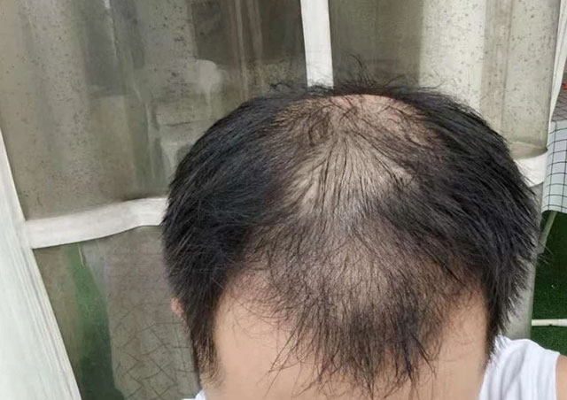 【現(xiàn)身說(shuō)法】瀘州小伙脫發(fā)，半個(gè)月禿頂，三個(gè)月逆襲……