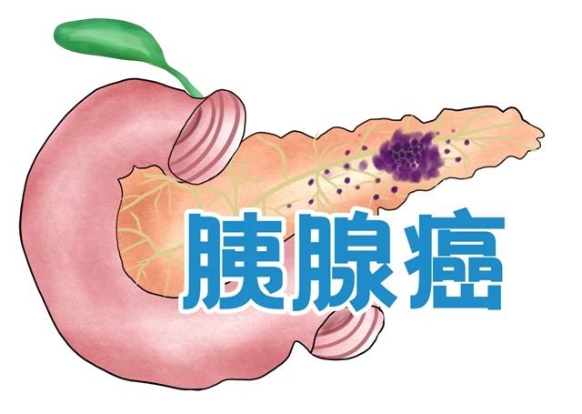 【發(fā)現(xiàn)即晚期】確診到去世僅2個(gè)月，癌中之王為什么這么“猛”？小心這些癥狀