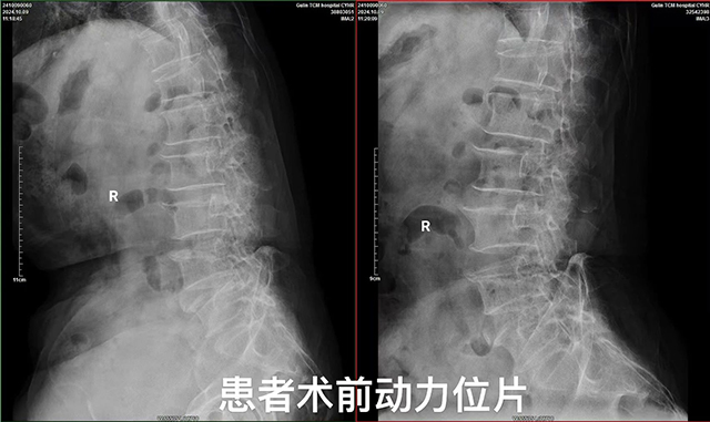 【?？萍夹g(shù)】古藺縣中醫(yī)醫(yī)院椎間孔鏡髓核摘除術(shù)：精準(zhǔn)祛痛，脊柱微創(chuàng)新希望！