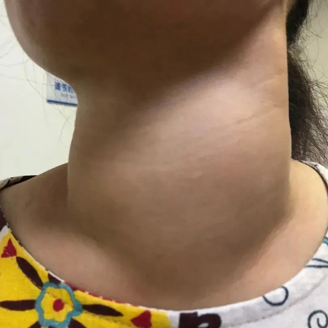 【圍觀】熬夜熬的是甲狀腺壽命！女主播總凌晨睡覺，脖子熬粗了