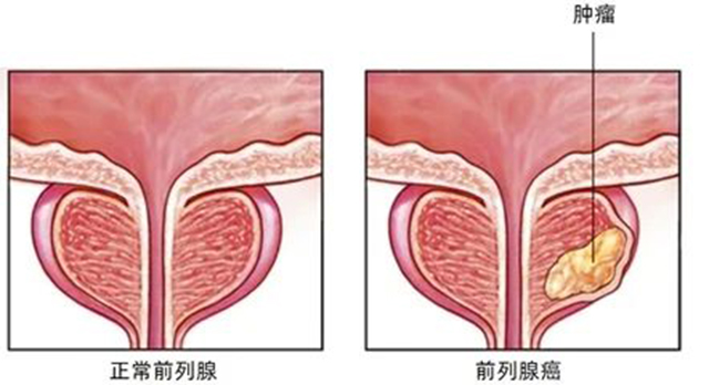 【提醒】父子三人先后確診同一種癌！醫(yī)生：早期無可識別癥狀
