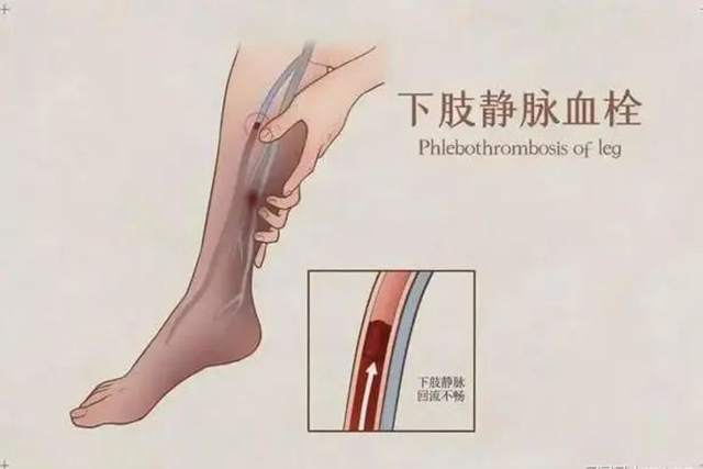 【關(guān)注】驚！置入濾器滯留男子體內(nèi)長達(dá)6年，險些……