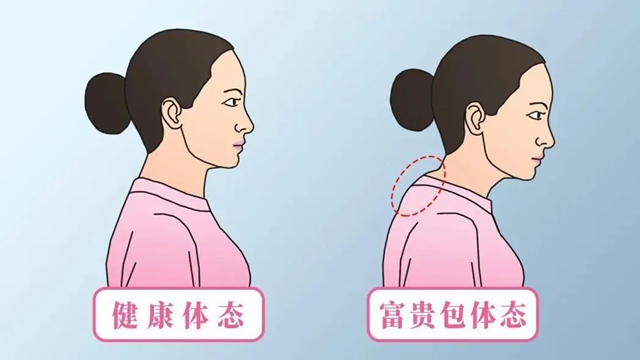 【科普講堂】改善頭前傾，消除富貴包，這4個動作超級有效！