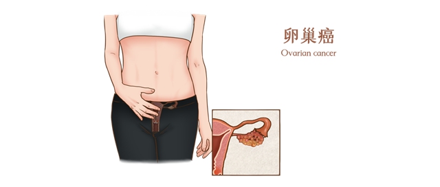 【擴(kuò)散】女子腹痛不適竟確診卵巢癌！出現(xiàn)這5個(gè)癥狀，一定要注意