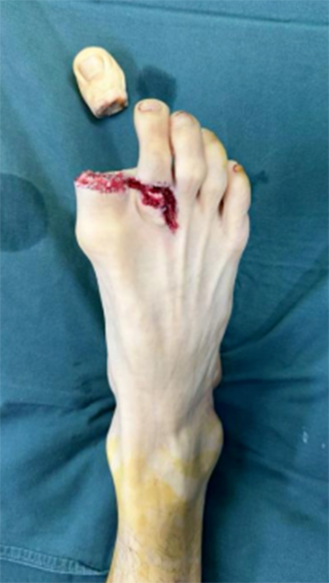 【可怕】男子腳趾硬生生被切斷……