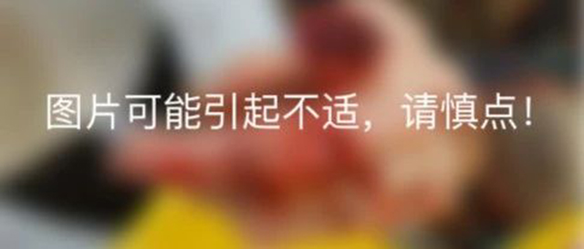 驚！一患者因故絞斷手指，竟將斷指浸泡在酒精里保存……