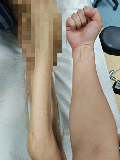 體重僅有60斤左右，瘦骨嶙峋的老人骨折了······