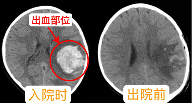【病例分享】古藺中醫(yī)人用仁心妙術(shù)點(diǎn)亮九歲患兒的希望之光！