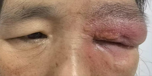 【病例分享】誤用草藥治療瞼黃瘤險(xiǎn)毀容？科學(xué)識(shí)別與處理指南助您避坑！