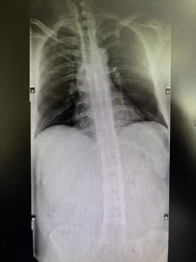 【圍觀】30歲小伙反復(fù)腰背疼痛，竟患“不死癌癥”！醫(yī)生：尚無根治方法