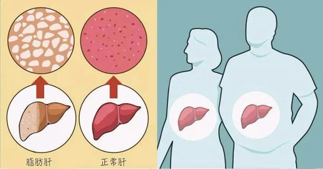 【關(guān)注】00后高中生也得脂肪肝？(圖7)