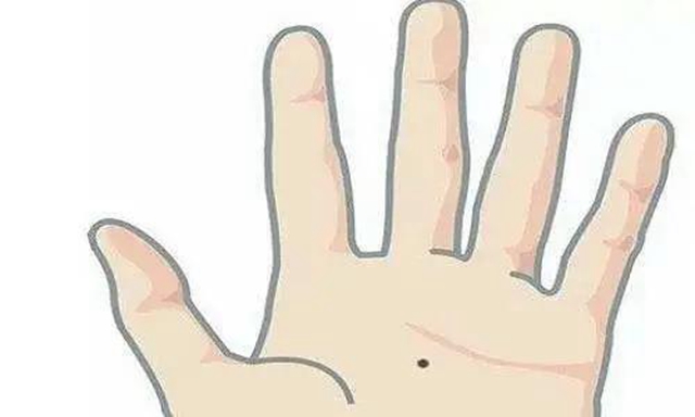 【當(dāng)心】這2個(gè)部位長(zhǎng)痣，可能會(huì)癌變？(圖3)