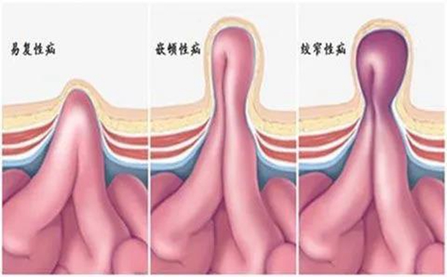 【厲害】指甲蓋大小手術(shù)切口治療疝氣！(圖8)