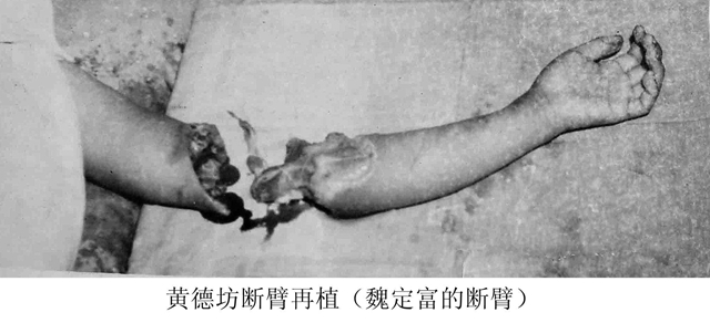 53年前，央廣向全世界播發(fā)：瀘州醫(yī)專附院為14歲少年成功接上斷臂！(圖4)