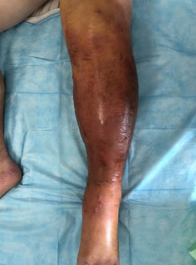 【圍觀】小腿腫成巨型“紅蘿卜”，瀘州男子中了什么毒？