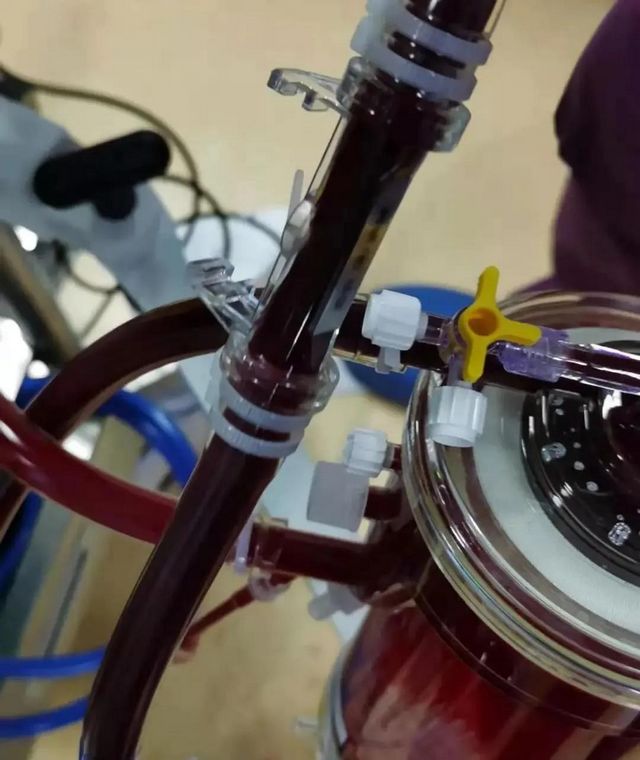 首例！救命的硬核武器—ECMO技術(shù)在西南醫(yī)大附院成功開展(圖5)