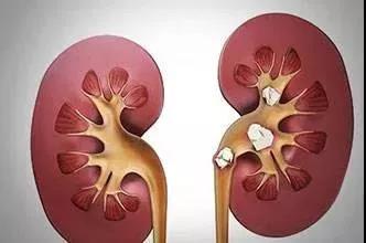 腎結(jié)石，大多是你吃出來的！(圖8)
