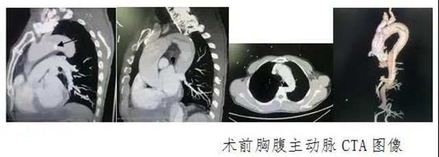 瀘州市人民醫(yī)院首次獨立成功完成復雜胸腹主動脈夾層血管腔內(nèi)修復術(shù)(圖2)