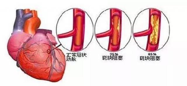 你的心臟在求救！急性心梗的這些預(yù)警信號(hào)， 你知道嗎？(圖2)