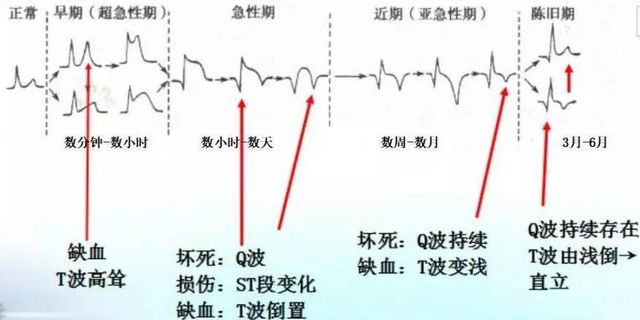 你的心臟在求救！急性心梗的這些預(yù)警信號(hào)， 你知道嗎？(圖9)
