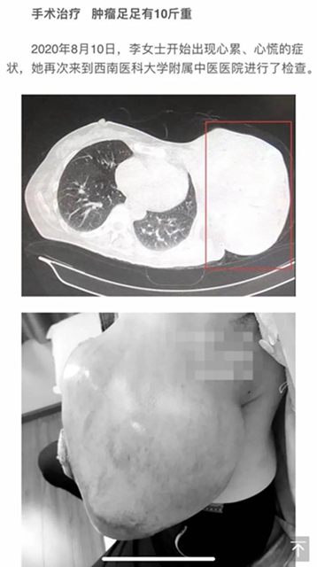 【圍觀】腫瘤這么大，一定是惡性了？