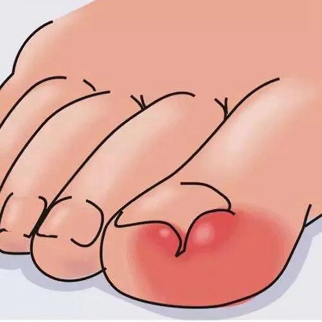 【擴散】腳指甲剪太短！代價可不只是痛……(圖2)