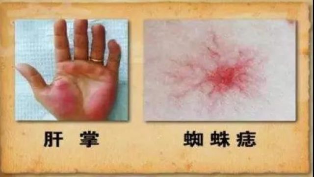 【關(guān)注】吳孟達患肝癌去世！這些信號要警惕？(圖8)