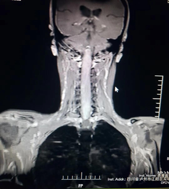 30厘米罕見腫瘤 ，10名醫(yī)療人員，連續(xù)11個(gè)小時(shí)的手術(shù)······(圖1)