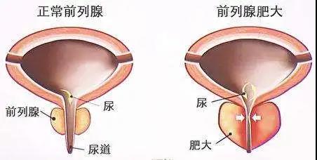 【擴散】男性專屬，一旦發(fā)現(xiàn)，大部分已是晚期？(圖2)