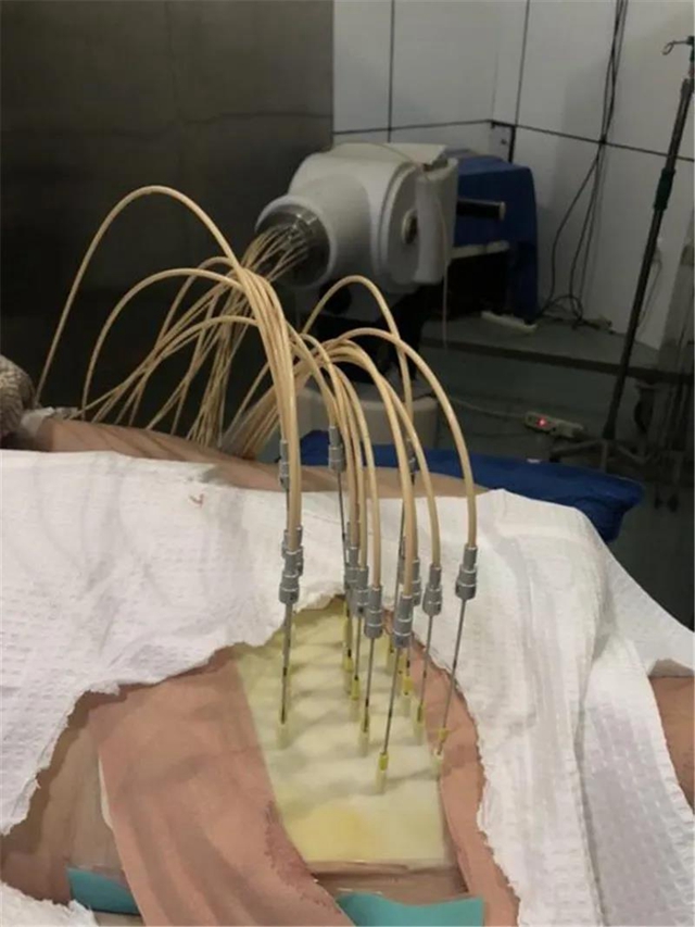 腫瘤難治？你還不知道西南醫(yī)大附竟有這項對付眾多腫瘤的領(lǐng)先技術(shù)！(圖13)