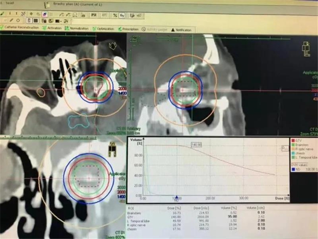 腫瘤難治？你還不知道西南醫(yī)大附竟有這項對付眾多腫瘤的領(lǐng)先技術(shù)！(圖15)