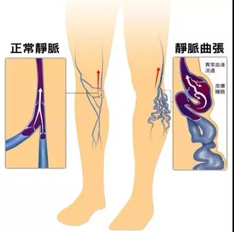 【圍觀】瀘州女教師小腿酸痛1個月，一雙美腿險些毀掉(圖5)