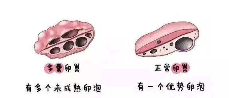 【提醒】女性多毛、月經(jīng)紊亂、痤瘡，當(dāng)心得了這個(gè)??！(圖4)