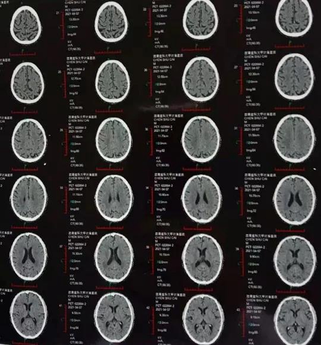 【震驚】男子腦中發(fā)現(xiàn)十余個(gè)腫瘤！還有救嗎？(圖4)