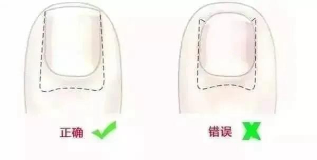 【擴散】腳指甲剪很短，感覺很爽？！代價卻很……(圖5)