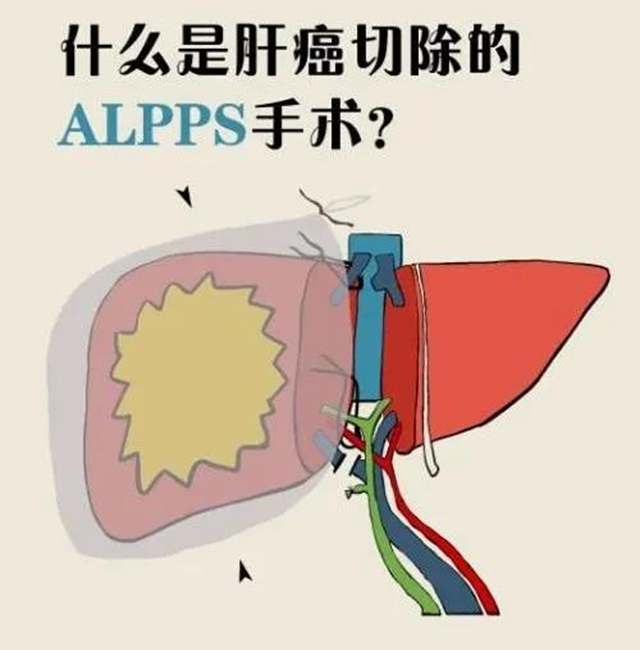 【擴(kuò)散】肝癌中晚期患者，可以根治啦？(圖4)