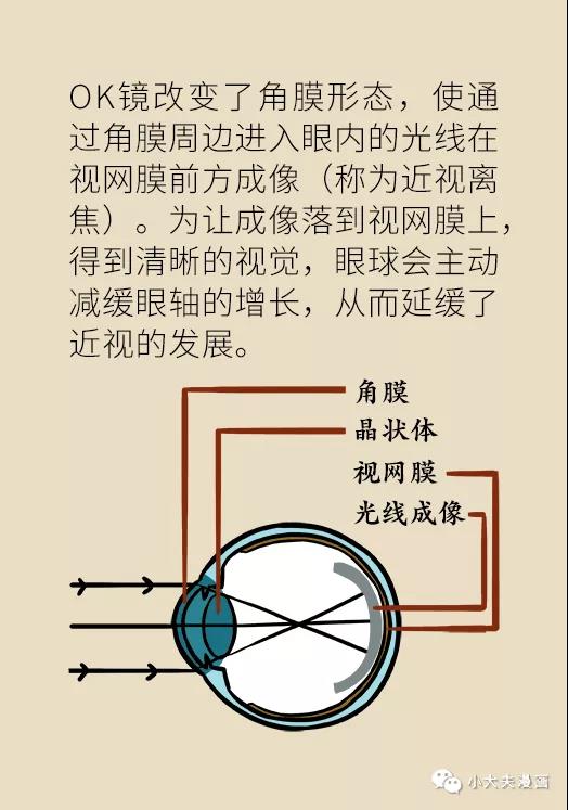 暑假到，配鏡忙，OK鏡真能緩解孩子近視？看專家解答(圖10)