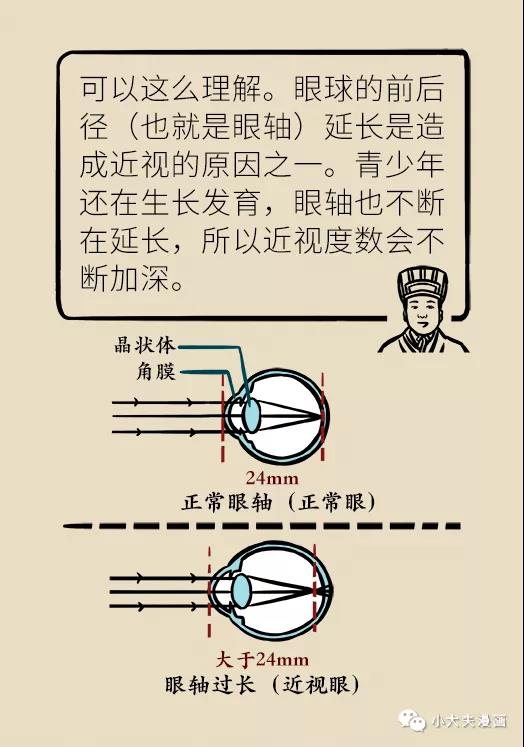 暑假到，配鏡忙，OK鏡真能緩解孩子近視？看專家解答(圖9)
