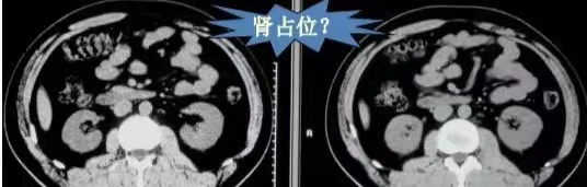 【圍觀】剛做完CT，醫(yī)生又讓做CT增強(qiáng)，有必要嗎？(圖6)