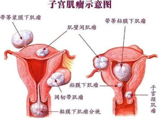 【女性】子宮肌瘤！該慌，還是不慌？(圖2)